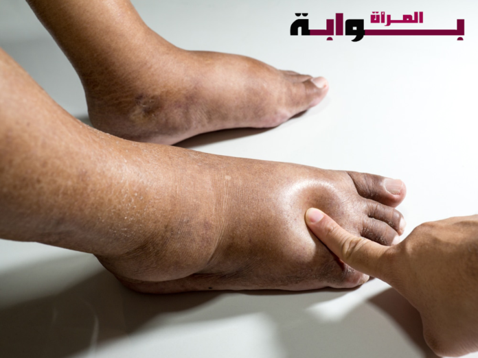 أسباب احتباس الماء في الجسم